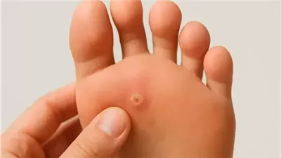 علاج مسمار القدم من البيت- 10 طرق طبيعية تخلصك من الكالو