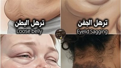 ترهل الجفن : بسبب قلة النوم، التدخين، القدم في العمر