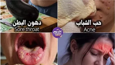 حب الشباب بسبب أكل جلد الدجاج دهون البطن الباذنجان يساعدك على التخلص من الدهون