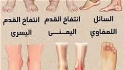 السائل اللمفاوي