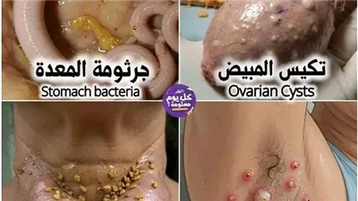 تكيس المبيض القرفة و تقليل