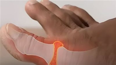 ما هو علاج ارتفاع حمض اليوريك؟ يمكن تقليل مستوياته بصورة طبيعية باتباع إرشادات بسيطة
